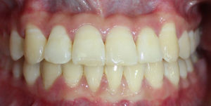 After Treatment Photo