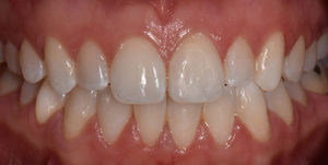 Openbite corrected using Invisalign Treatment