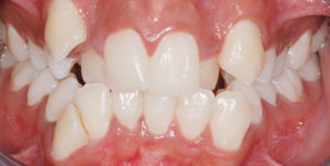 Before Treatment Photo