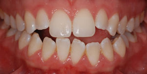 Openbite before Invisalign Treatment