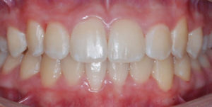 Aligned teeth after Invisalign treatment