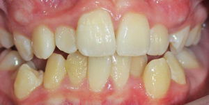 Misaligned teeth before Invisalign Treatment
