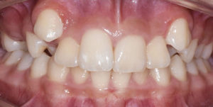 Before Treatment Photo
