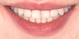 Protruded teeth corrected using Invisalign Aligners