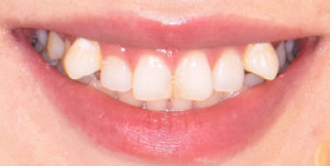 Protruded teeth before Invisalign Treatment