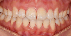 After Treatment Photo
