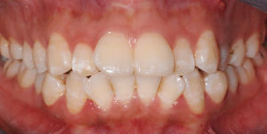 Before Treatment Photo