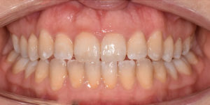 After Treatment Photo
