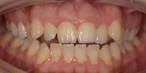 Before Treatment Photo