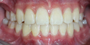 Perfectly aligned teeth after Invisalign Treatment
