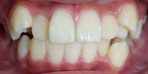 Crowded teeth before Invisalign Treatment