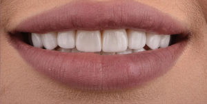 After Treatment Photo