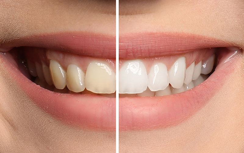 advanced zoom teeth whitening