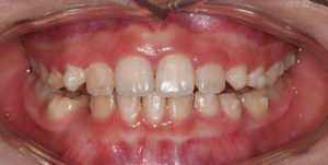 Overbite corrected using Invisalign treatment