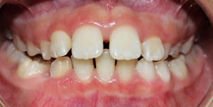 Overbite before Invisalign treatment image