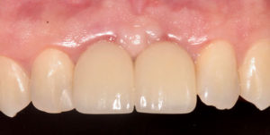 After Treatment Photo