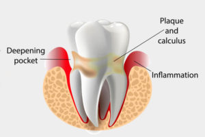 Periodontal Disease