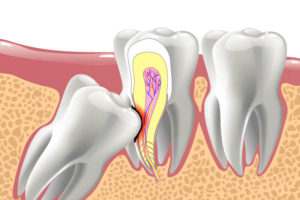 impacted tooth