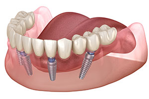 all on four dental implant vector