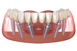 all on six dental implant