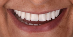 After Treatment Photo