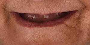 Before Treatment Photo
