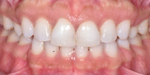 After Treatment Photo
