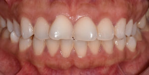 Before Treatment Photo