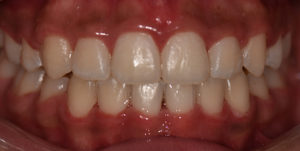 After Treatment Photo