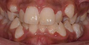 Before Treatment Photo