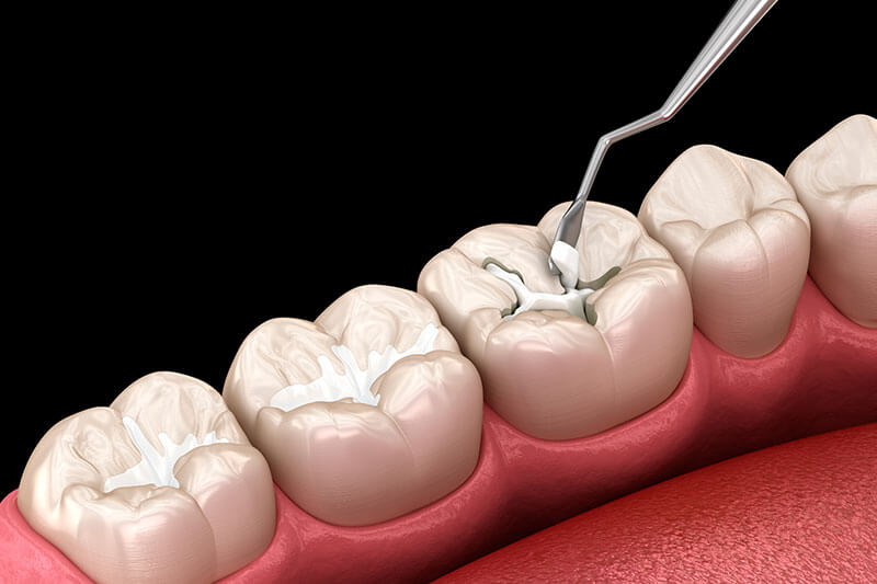 ceramic and composite fillings procedure