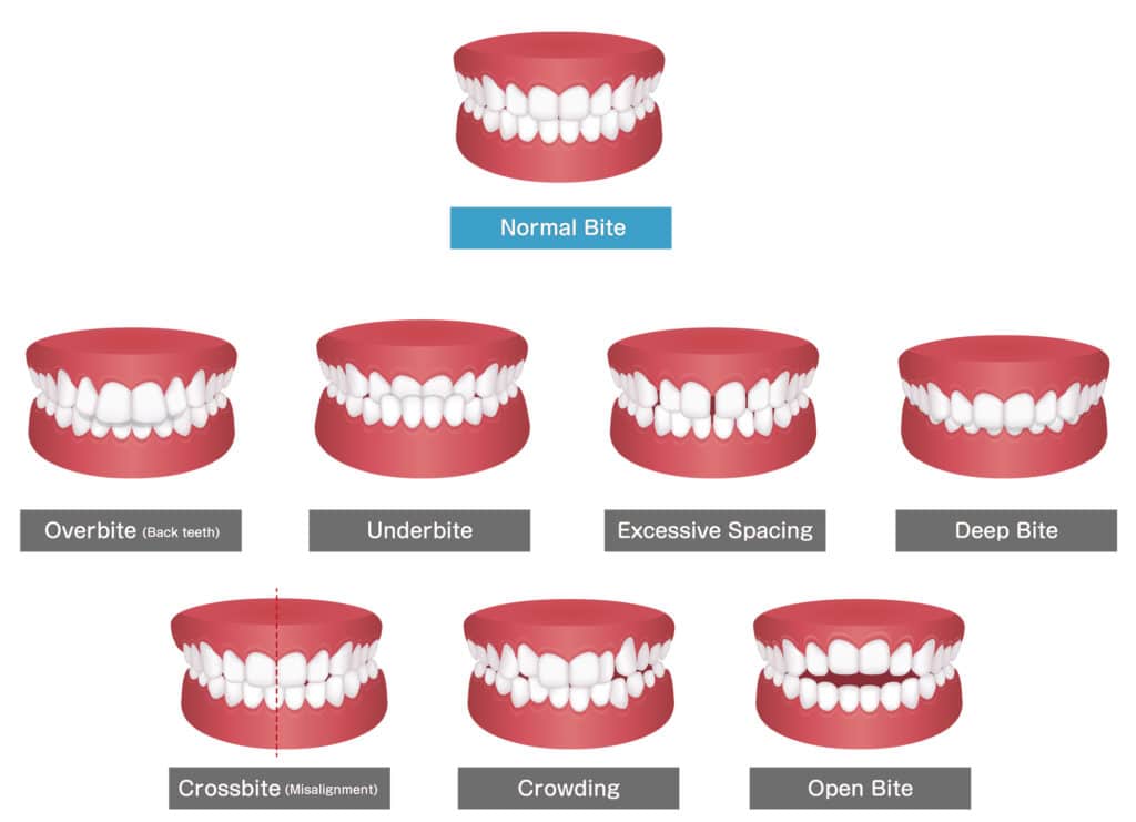 illustration of bite types