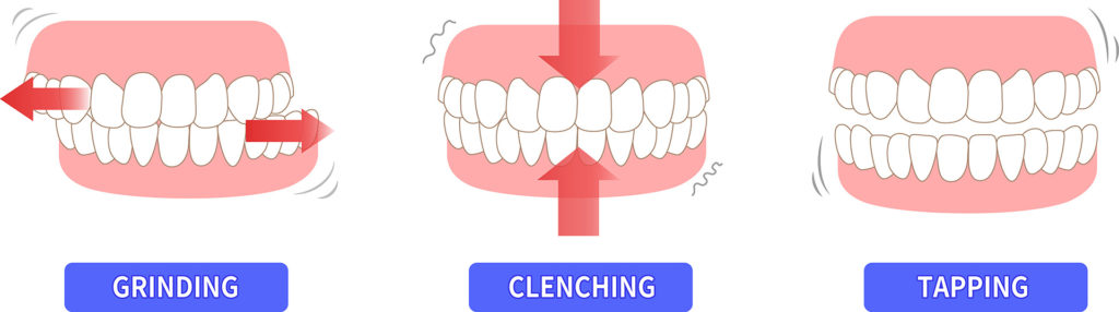 illustration-teeth-bruxism