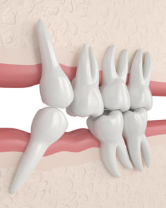 3d render of teeth sliding towards the area of missing tooth in order to fill the gap. Consequences of lower tooth loss.