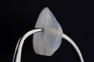 dental-veneers-material