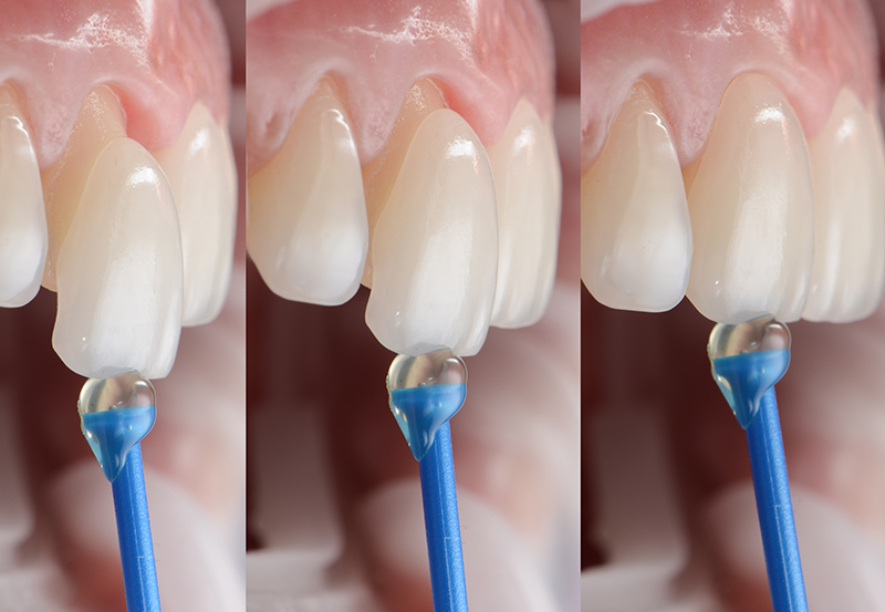 dental-veneers-on-teeth