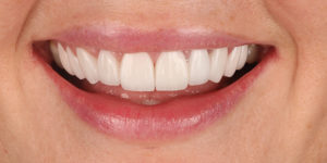 After Treatment Photo