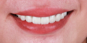 After Treatment Photo