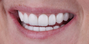 After Treatment Photo
