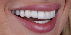 After Treatment Photo