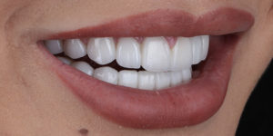 After Treatment Photo