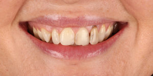 Before Treatment Photo