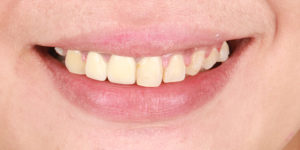 Before Treatment Photo