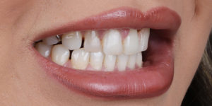 Before Treatment Photo