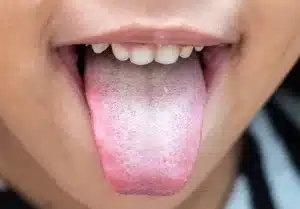 oral thrush