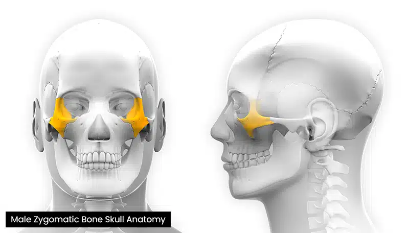 img skull anatomy zygomatic implants