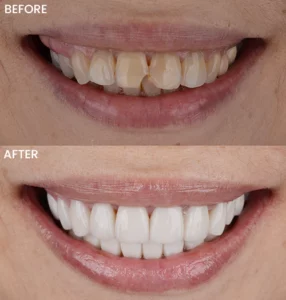 img chipped tooth before after