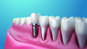 img dental implants 1