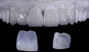 No Prep Feldspathic Veneers