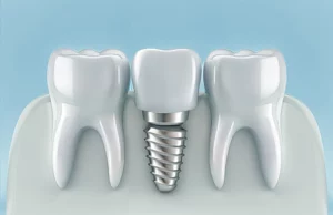 img dental implants